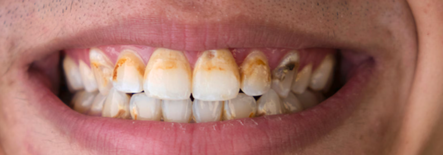 Cara Menghilangkan Gigi Kuning